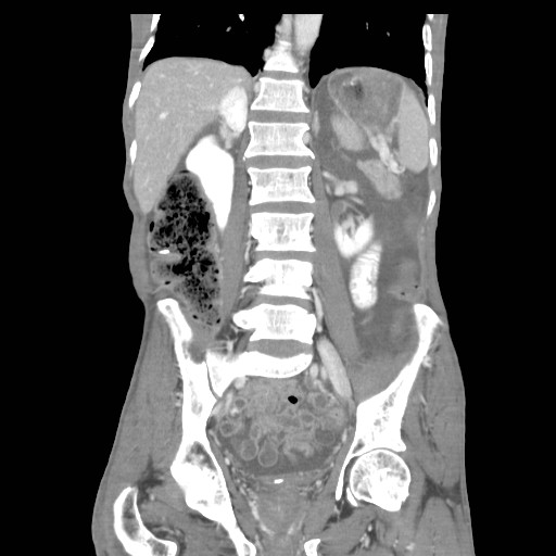 File:Acute pancreatitis (Radiopaedia 50213-55558 Coronal C+ portal venous phase 29).jpg