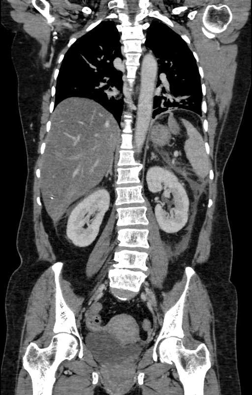 Acute pancreatitis (Radiopaedia 80007-93285 Coronal C+ portal venous phase 94).jpg