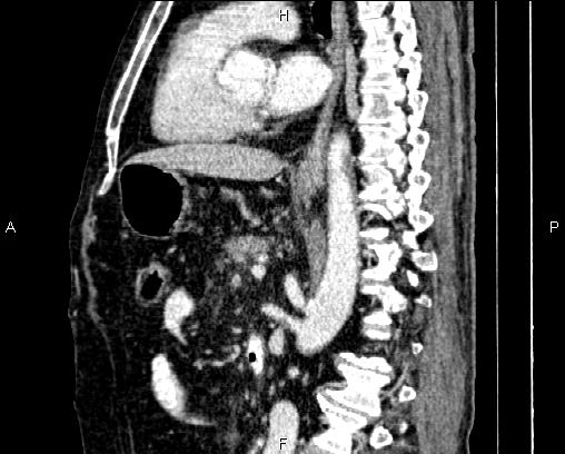 Acute pancreatitis (Radiopaedia 85146-100701 Sagittal C+ portal venous phase 52).jpg