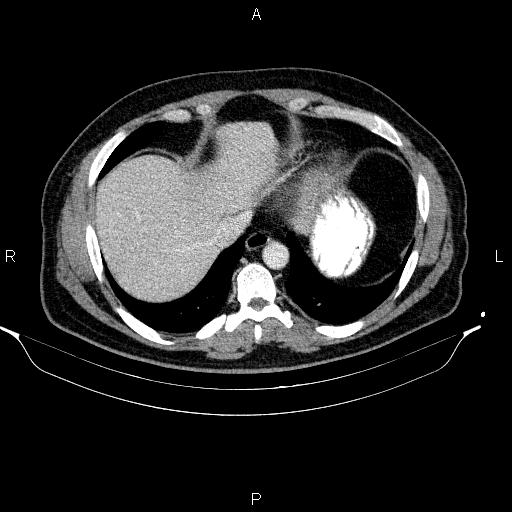 Acute pancreatitis (Radiopaedia 85390-101010 Axial C+ portal venous phase 12).jpg
