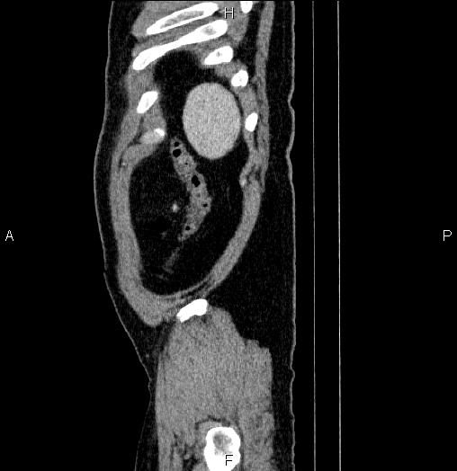 Acute pancreatitis (Radiopaedia 85390-101010 Sagittal C+ portal venous phase 99).jpg