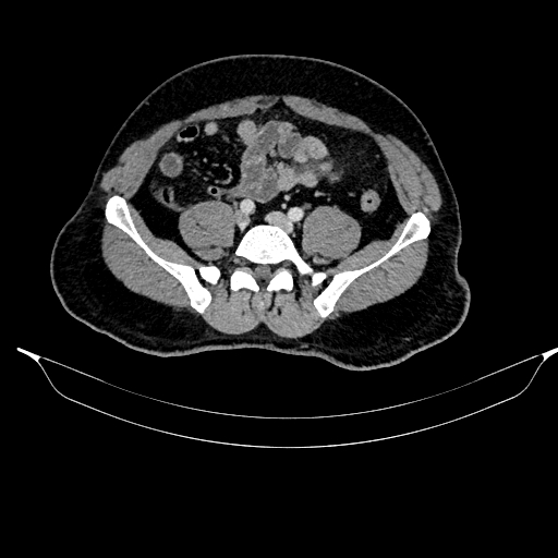 Acute pancreatitis (Radiopaedia 87428-103757 Axial C+ portal venous phase 70).jpg