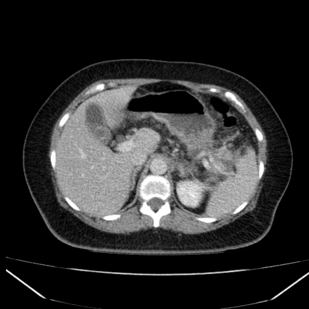 Acute pancreatitis - Balthazar C (Radiopaedia 26569-26714 Axial C+ portal venous phase 32).jpg