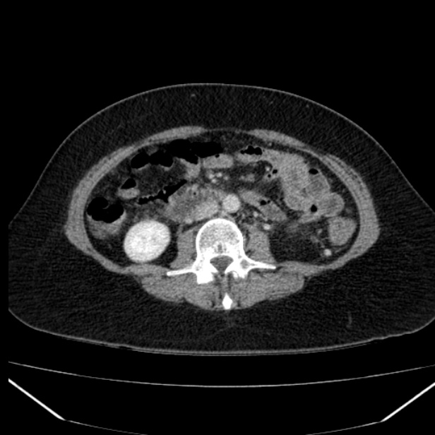 Acute pancreatitis - Balthazar C (Radiopaedia 26569-26714 Axial C+ portal venous phase 53).jpg