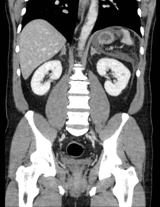 Acute pancreatitis - Balthazar E (Radiopaedia 23080-23110 Coronal C+ portal venous phase 52).jpg