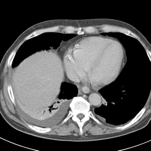 Acute pancreatitis and walled-off necrosis (Radiopaedia 29888-30403 Axial C+ delayed 9).jpg