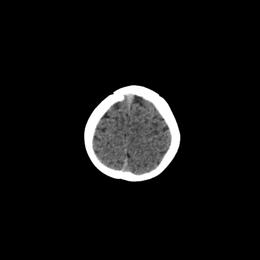 Acute phase of hemiconvulsion-hemiplegia epilepsy syndrome (Radiopaedia 29309-29744 Axial non-contrast 7).jpg