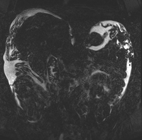 Acute portal vein thrombosis (Radiopaedia 73198-83925 Coronal Heavily T2 thin cuts 44).jpg