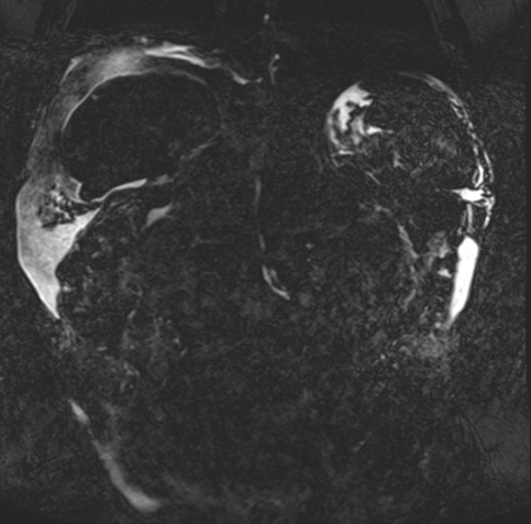Acute portal vein thrombosis (Radiopaedia 73198-83925 Coronal Heavily T2 thin cuts 60).jpg