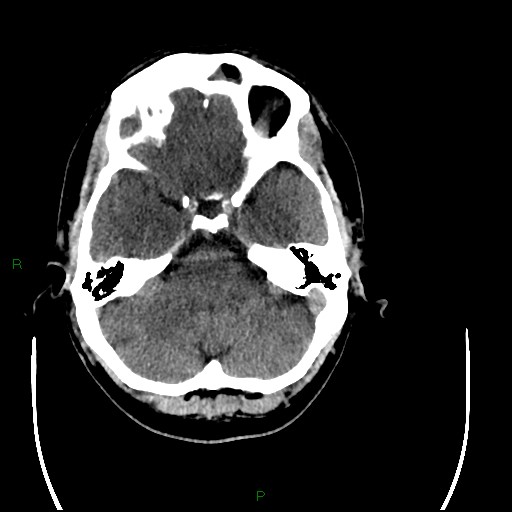 File:Acute posterior cerebral artery territory infarct (Radiopaedia 79329-92393 Axial non-contrast 27).jpg