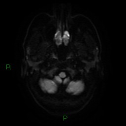 Acute posterior cerebral artery territory infarct (Radiopaedia 79329-92394 Axial DWI 4).jpg