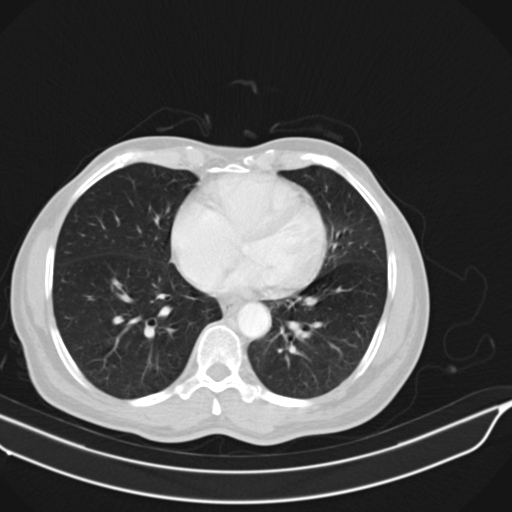 Acute pulmonary embolism (Radiopaedia 69510-79390 Axial lung window 58).jpg