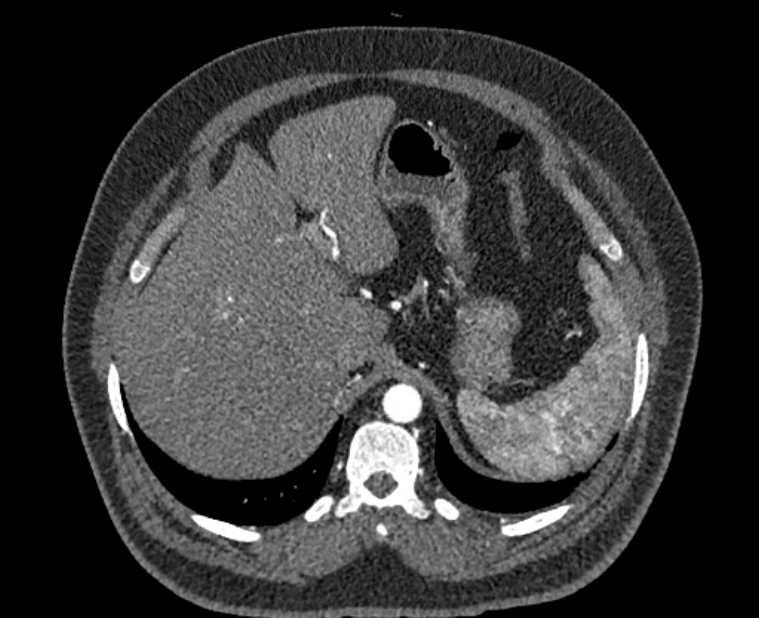 Acute pulmonary embolism with pulmonary infarcts (Radiopaedia 77688-89908 Axial C+ CTPA 68).jpg