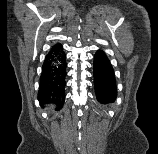 Acute pulmonary embolism with pulmonary infarcts (Radiopaedia 77688-89908 Coronal C+ CTPA 97).jpg
