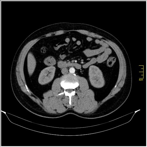Acute right sided diverticulitis (Radiopaedia 65249-74268 Axial C+ portal venous phase 36).JPG