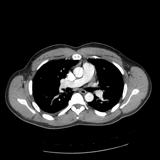 File:Acute segmental pulmonary emboli and pulmonary infarction (Radiopaedia 62264-70444 Axial C+ CTPA 52).jpg