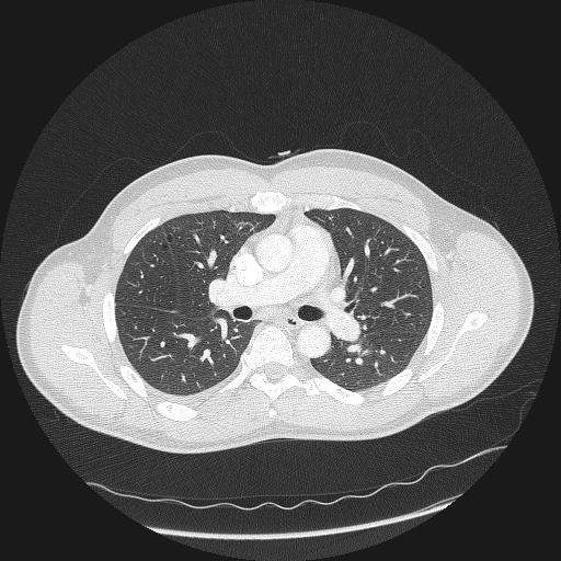 Acute segmental pulmonary emboli and pulmonary infarction (Radiopaedia 62264-70444 Axial lung window 77).jpg