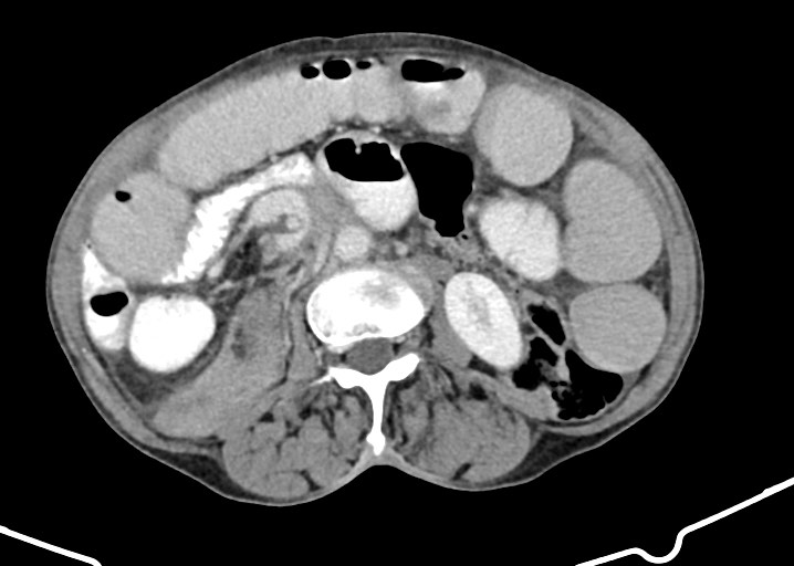 File:Acute small bowel (ileal) volvulus (Radiopaedia 71740-82139 Axial C+ portal venous phase 101).jpg