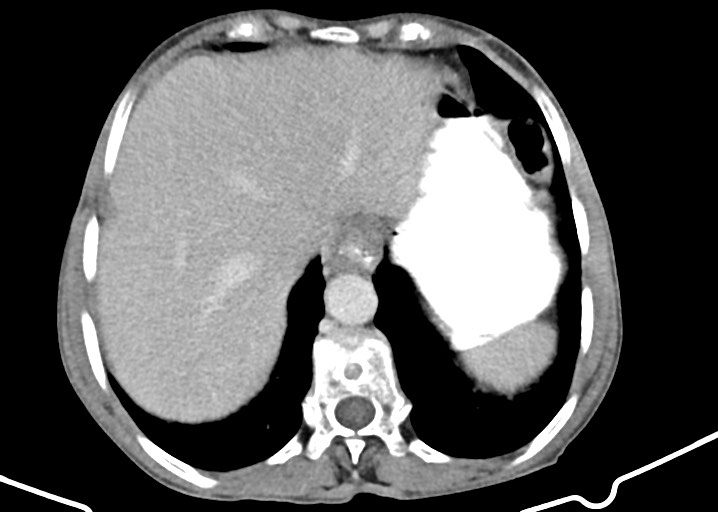 Acute small bowel (ileal) volvulus (Radiopaedia 71740-82139 Axial C+ portal venous phase 47).jpg