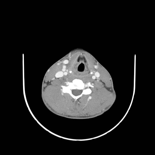 File:Acute submandibular sialadenitis secondary to ductal stone (Radiopaedia 27999-28267 Axial C+ delayed 32).jpg