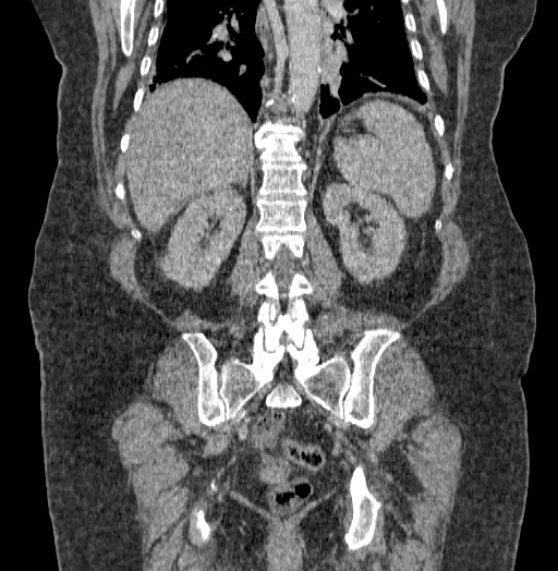 Acute superior mesenteric artery occlusion (Radiopaedia 51288-56960 Coronal C+ portal venous phase 55).jpg