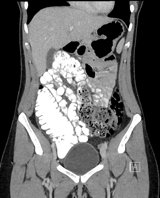 Acute uncomplicated appendicitis (Radiopaedia 61374-69304 Coronal C+ portal venous phase 33).jpg
