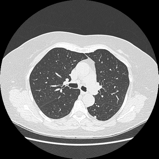 Adenocarcinoma in situ of lung (Radiopaedia 38685-40829 B 91).png