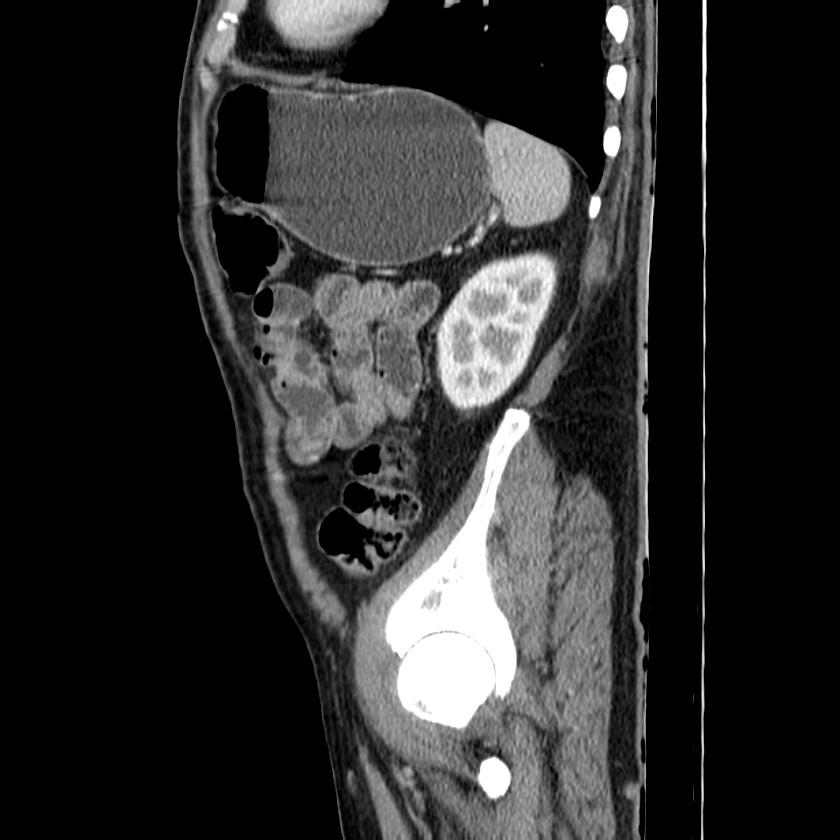 Adenocarcinoma of colon with entero-colic fistula (Radiopaedia 22832-22852 Sagittal C+ portal venous phase 51).jpg