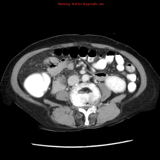 File:Adenocarcinoma of the colon (Radiopaedia 8191-9039 Axial liver window 41).jpg