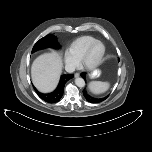 Adenocarcioma of rectum- T1 lesion (Radiopaedia 36921-38547 Axial C+ portal venous phase 11).png