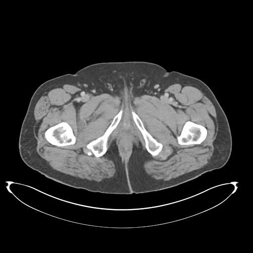 Adenocarcioma of rectum- T1 lesion (Radiopaedia 36921-38547 Axial C+ portal venous phase 95).png