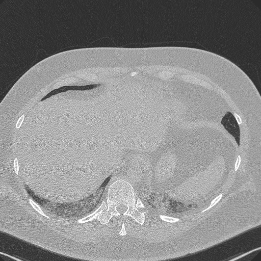 Adenoid cystic carcinoma of the trachea (Radiopaedia 49042-54137 Axial lung window 291).jpg