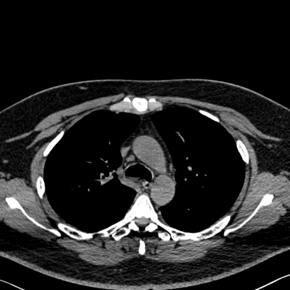 Adenoid cystic carcinoma of the trachea (Radiopaedia 49042-54137 Axial non-contrast 110).jpg