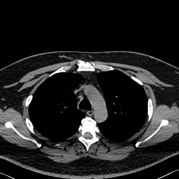 File:Adenoid cystic carcinoma of the trachea (Radiopaedia 49042-54137 Axial non-contrast 96).jpg
