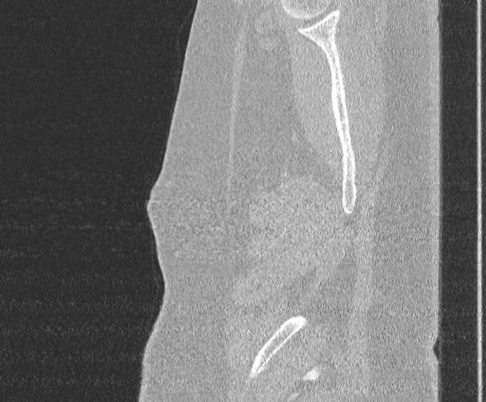 Adenoid cystic carcinoma of the trachea (Radiopaedia 49042-54137 Sagittal lung window 14).jpg