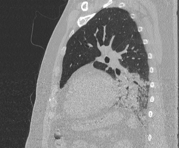 File:Adenoid cystic carcinoma of the trachea (Radiopaedia 49042-54137 Sagittal lung window 317).jpg