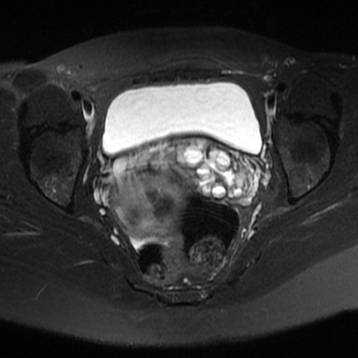 File:Adenoma malignum of cervix (Radiopaedia 66441-75705 Axial T2 fat sat 9).jpg