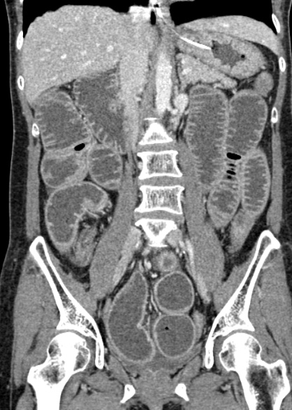 Adhesional small bowel obstruction (Radiopaedia 48397-53305 Coronal C+ portal venous phase 188).jpg
