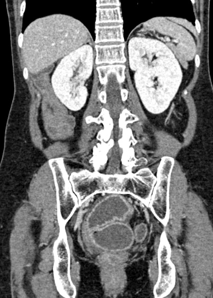 Adhesional small bowel obstruction (Radiopaedia 48397-53305 Coronal C+ portal venous phase 248).jpg