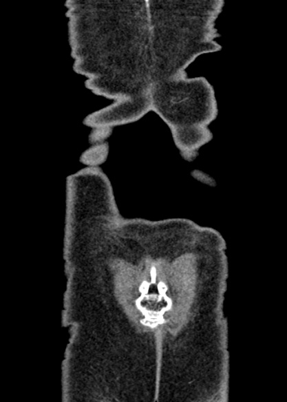 Adhesional small bowel obstruction (Radiopaedia 48397-53305 Coronal C+ portal venous phase 343).jpg