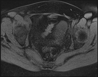 File:Adnexal multilocular cyst (O-RADS US 3. O-RADS MRI 3) (Radiopaedia 87426-103754 Axial 184).jpeg