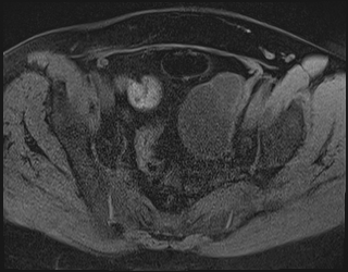 File:Adnexal multilocular cyst (O-RADS US 3. O-RADS MRI 3) (Radiopaedia 87426-103754 Axial 187).jpeg