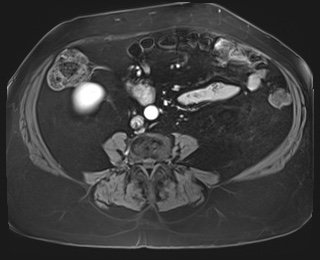 Adrenal cortical carcinoma (Radiopaedia 64017-72770 I 65).jpg