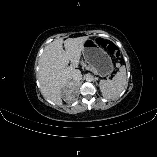 Adrenal cortical carcinoma (Radiopaedia 84882-100379 Axial C+ delayed 20).jpg