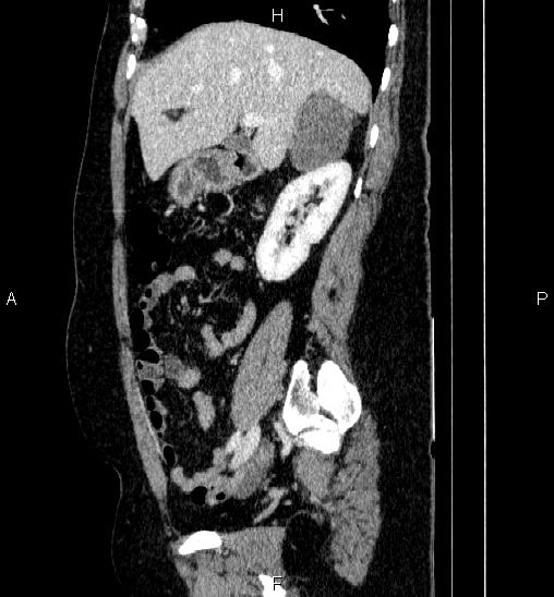 Adrenal cortical carcinoma (Radiopaedia 84882-100379 Sagittal C+ portal venous phase 30).jpg