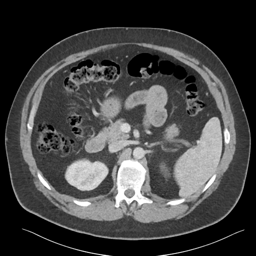 File:Adrenal cyst (Radiopaedia 45625-49777 Axial C+ portal venous phase 39).png