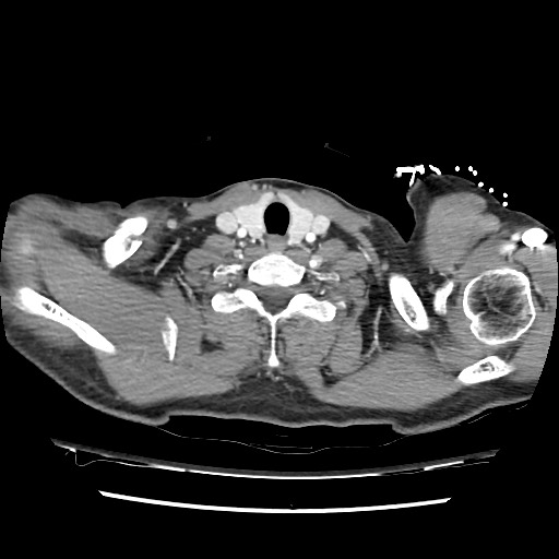 Adrenal gland trauma (Radiopaedia 81351-95078 Axial Dual bolus trauma C+ 8).jpg