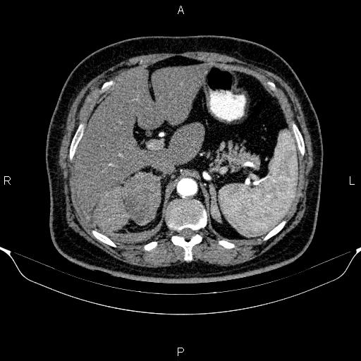 Adrenal hemorrhage (Radiopaedia 62622-70916 Axial C+ arterial phase 95).jpg