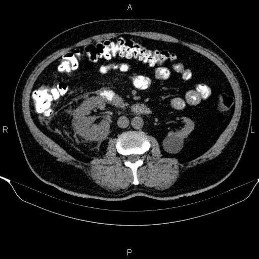 Adrenal hemorrhage (Radiopaedia 62622-70916 Axial non-contrast 92).jpg
