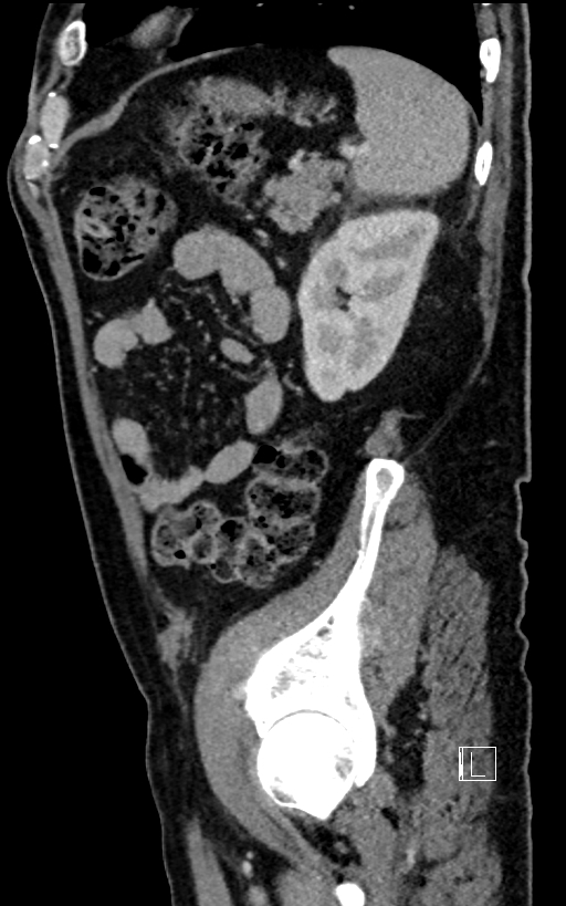 Adrenal lymphoma (Radiopaedia 73730-84529 Sagittal C+ portal venous phase 86).jpg